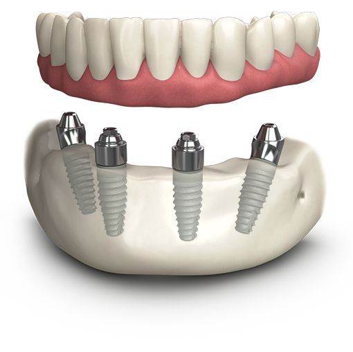 Bridge complet sur implant